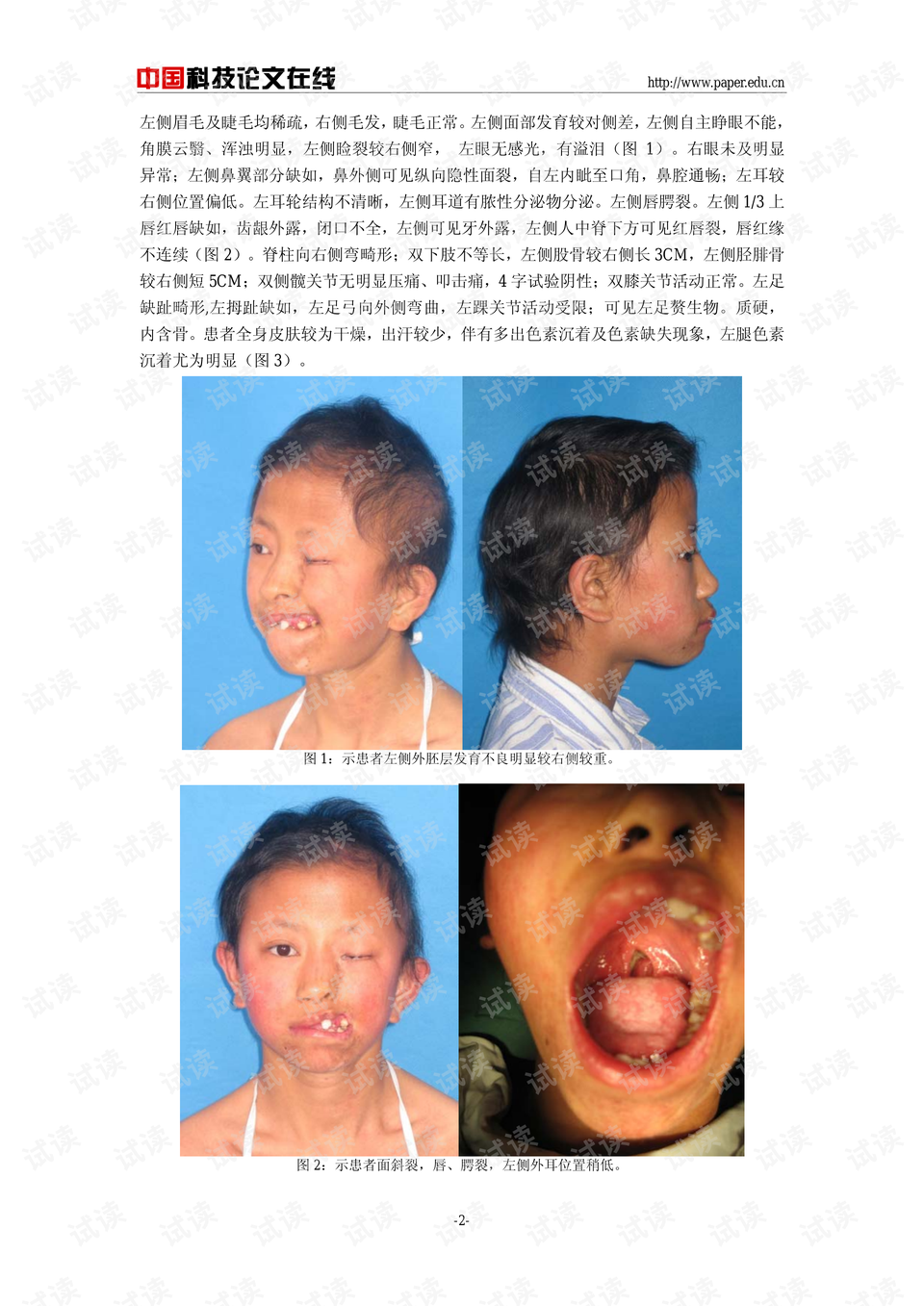 先天性缺指(趾)-外胚层发育不良-唇/腭裂综合征的临床