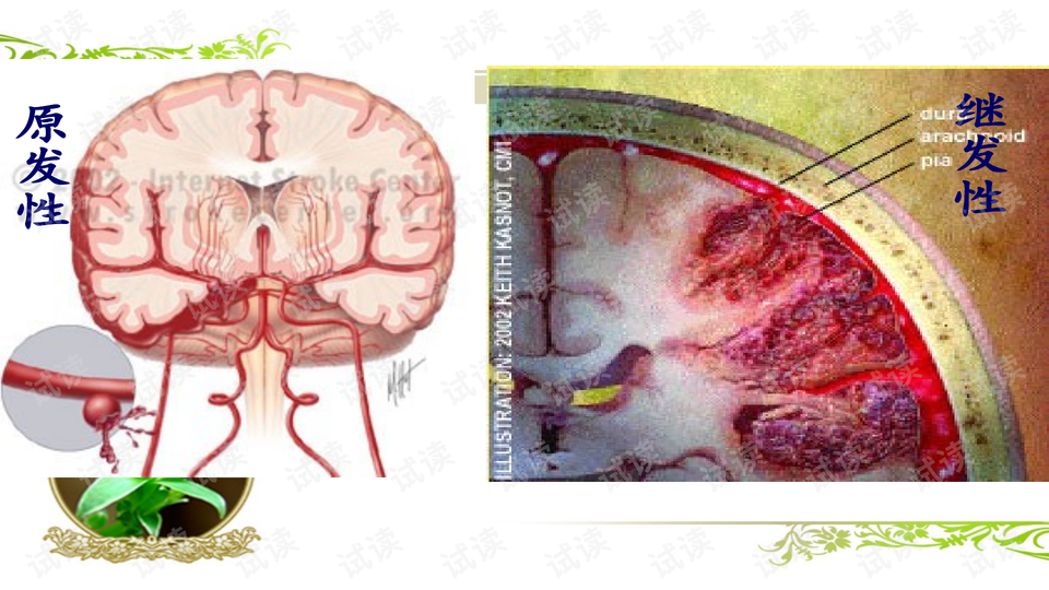 蛛网膜下腔出血ppt课件.ppt